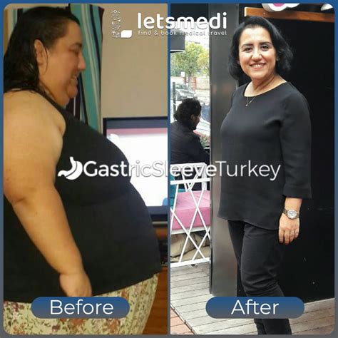 gastric sleeve turkey reviews